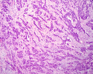 Undifferentiated adenocarcinoma. Metastatic nodule