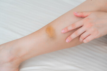 View on the woman leg with bruise, hematoma