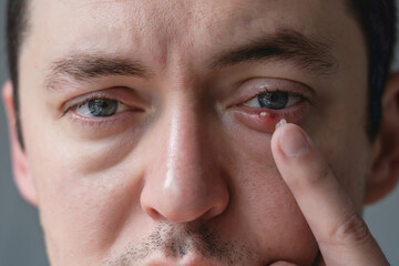 Infected chalazion (stye, barley) or hordeolum eye on lower eyelid of man