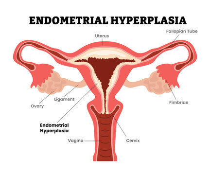 Endometrial Hyperplasia or intraepithelial neoplasia, female reproductive system, educational medical poster design healthcare scheme, labeled internal organs cervix, fertility problem infertility