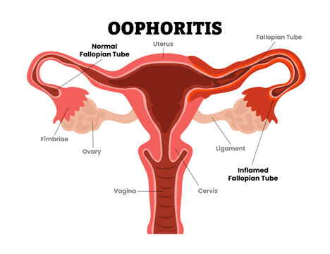 Oophoritis or ovaritis, ovary inflammation, female reproductive system, educational medical poster design healthcare scheme, labeled internal organs cervix, fertility problem infertility.