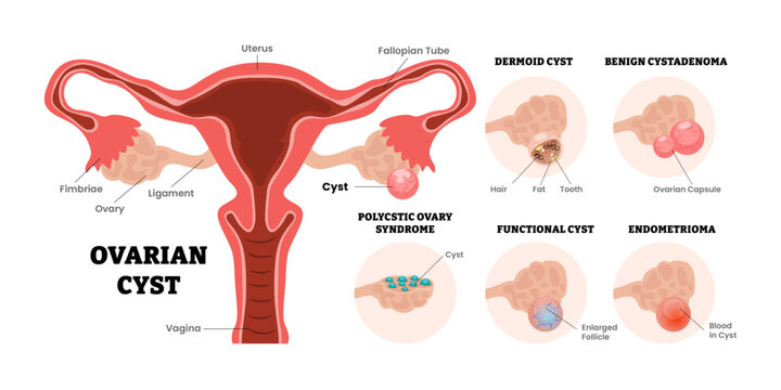 Different types of ovarian cyst types set collection, female reproductive system, educational medical poster design healthcare scheme, labeled internal organs cervix, fertility problem infertility.
