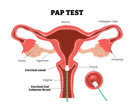 Pap Test, Pap smear or cervical cytology, female reproductive system, educational medical poster design healthcare scheme, internal organs cervix, fertility problem infertility, screening test.