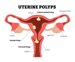 Uterine Polyps Endometrial Polyps, sessile, pedunculate, cervical,female reproductive system, educational medical poster design healthcare scheme, internal organs cervix, fertility problem infertility