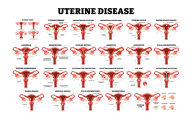 Different types of Uterine Disease set collection, female reproductive system, educational medical poster design healthcare scheme, labeled internal organs cervix, fertility problem infertility.