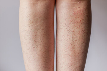 Female legs with red irritation and visible hair after painful epilation procedure, skin issue...
