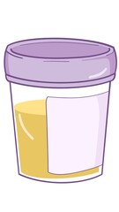 Urinalysis, urine in a medical plastic container
