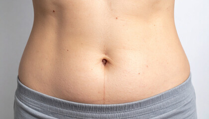 Close-up of a woman's lower abdomen with a faint skin mark or line