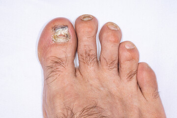 Right foot with nail fungus thickened, discolored and ragged in the big toe and the second toe. Long nails and toe hair in white background. Macrophotograph with bright twin macro flash lights.