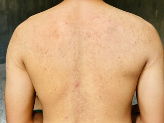 Naklejka premium prickly heat on the back of Asian men, allergies, germs on the skin