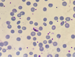 This is plasmodium falciparum gametocyte form stage by microscopic 100x lens causing malaria. by thin film method.