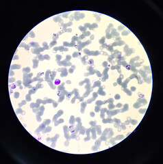 This is plasmodium vivax amoeboid form stage by microscopic 100x lens causing malaria. by giemsa stain method.