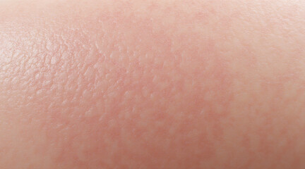 Fototapeta premium Close-Up View of Human Skin Texture with Light Red Bumps and Mild Irritation