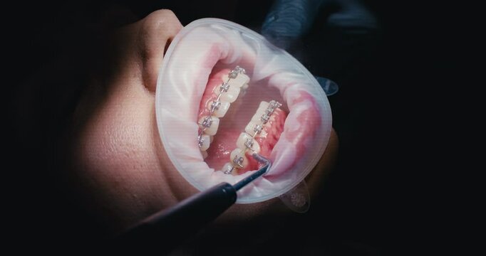 Close-up of bericte rinsing with instruments in a stomatology clinic. Metal braces on the teeth of a young woman. 