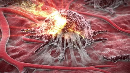 Tumor, cancer cell treatment. Tumors are killed by chemotherapy and radiotherapy. Various tumors in human organs, covered with vascular network, tumor environment, oncology 3D animation.
