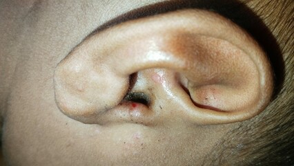 Close-up of a child’s ear showing signs of irritation and possible infection—highlighting the discomfort and need for gentle care
