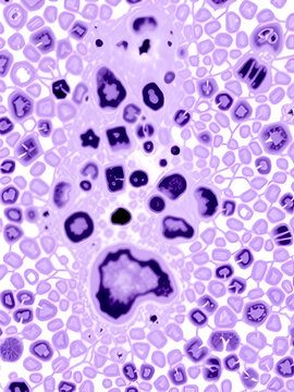 Mixed parotid tumor, photomicrograph showing epithelial and myoepithelial cell components within chondromyxoid stroma, typical of pleomorphic adenoma.