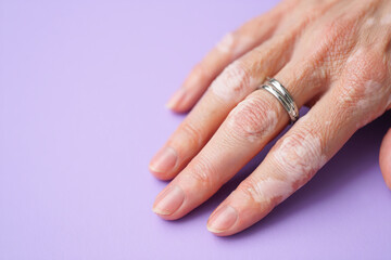 Close‑up of vitiligo patches on skin hand, ring, cup – Generative AI