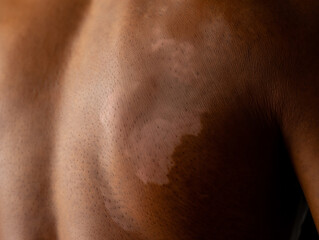 Fototapeta premium Close‑up of vitiligo patches on dark skin– Generative AI