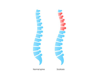 Scoliosis medical poster