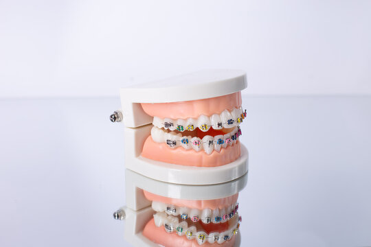 Dentist's work in dental office, showing jaw with braces. Orthodontic treatment, dental care concept