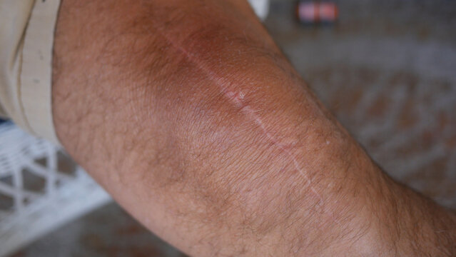 A Knee Surgery Scar On Adult Male for Knee Operation 2