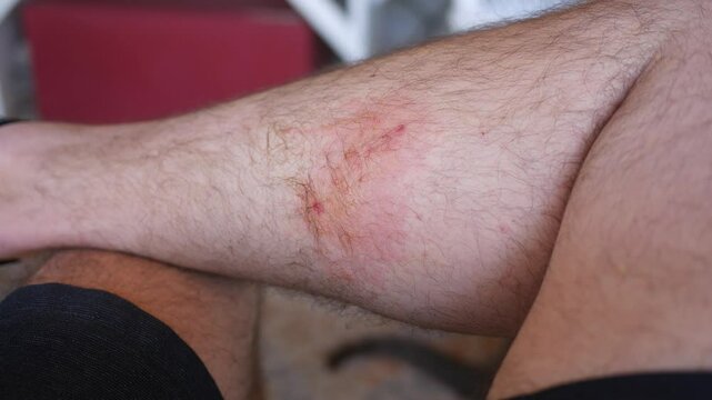 Poison Ivy on Caucasian Man's Leg 3