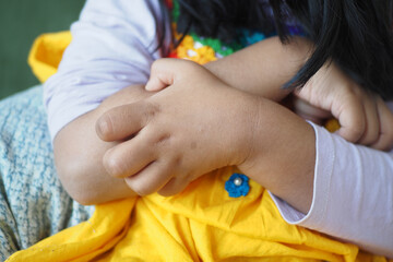 Child suffering itching skin on her arm 