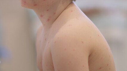 Fototapeta premium Child with a Skin Condition chickenpox has Experience in Receiving Pediatric Healthcare and Care