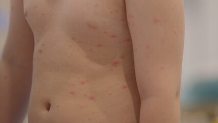 Chickenpox. A child experiencing skin irritation or a rash may require careful observation and treatment