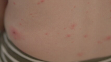 Fototapeta premium Detailed closeup view of skin revealing a prominent rash chickenpox or possible allergic reaction