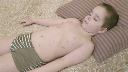A child with a skin condition chickenpox peacefully resting on their bed, showcasing their...