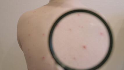 CloseUp Observation of Skin Featuring chickenpox Bumps Under a Magnifying Glass Lens