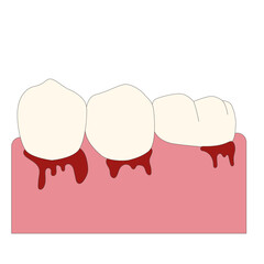 Gum bleeding