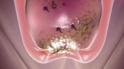 Vaginitis,Viruses and inflammation invade the vagina, and the uterus recovers under the action of medicines,3d animation.