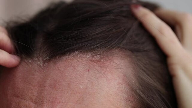 Woman scratching scalp because of dermatitis and dandruff. 4K, slow motion.