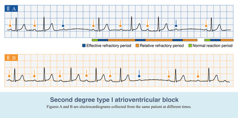 When the PR interval is progressively prolonged with QRS wave shedding , the ECG is second degree type I atrioventricular block. The majority of the blocked sites are the atrioventricular nodes.
