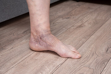 vascular dilation of veins on legs. Woman anonymous