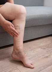 skin care for legs with varicose veins