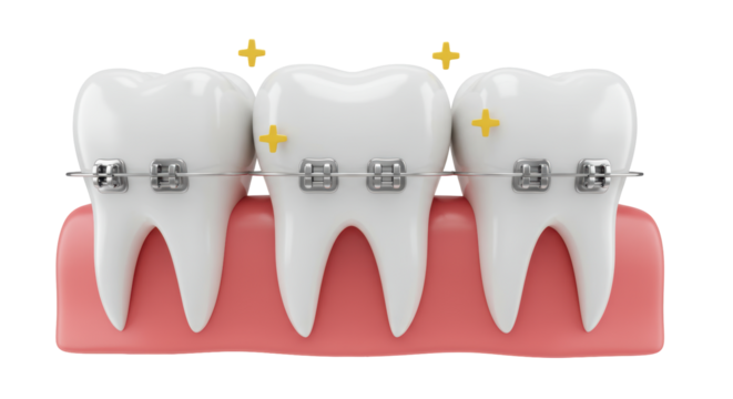 Isolated Teeth with Braces