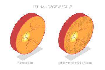 3D Isometric Flat  Illustration of Retinal Degenerative , Vision Impairment, Blind Spots