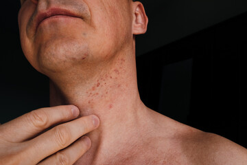 Naklejka premium Skin irritation after shaving. Skin irritation on male neck after shaving. Close-up photo.