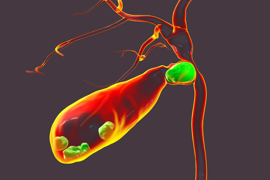 Mirizzi syndrome, 3D illustration showing compression of the common hepatic duct by an impacted gallstone in the cystic duct, causing obstructive jaundice and inflammation.