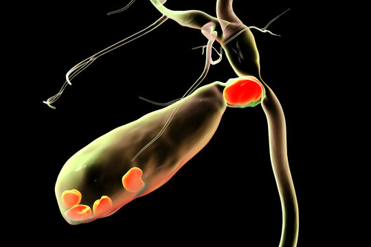 Mirizzi syndrome, 3D illustration showing compression of the common hepatic duct by an impacted gallstone in the cystic duct, causing obstructive jaundice and inflammation.