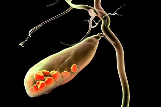 Gallbladder with stones, 3D illustration showing cholelithiasis. Gallstones can block bile flow and cause pain, inflammation, or infection requiring medical or surgical treatment.