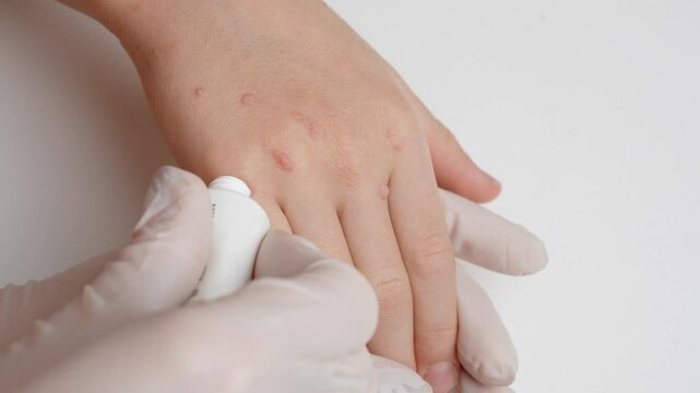 Doctor in gloves examining child's hand with viral warts, applying wart remover from tube, close-up. HPV. Verruca vulgaris, papillomavirus. Pediatric dermatology, skin diseases, getting rid of warts