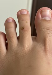 Close-up Foot Image: Brown Lesions on Toe, Realistic Style