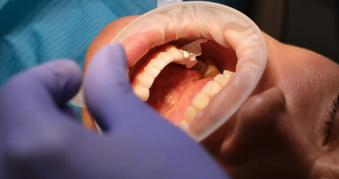 Dentist applies dental veneer on patient teeth using optragate in clinic. Doctor ensures precise and comfortable treatment on dentistry procedure