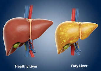Healthy versus fatty liver illustration