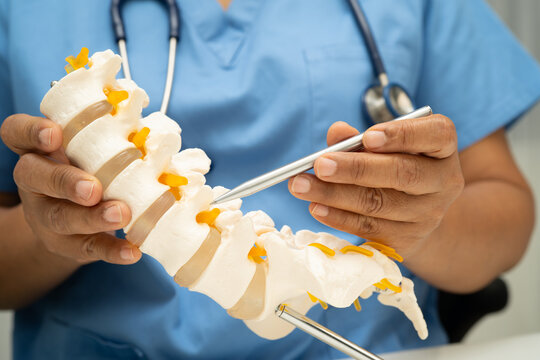 Asian doctor holding spinal nerve and bone model, Lumbar spine displaced herniated disc fragment for treatment medical in the orthopedic department.